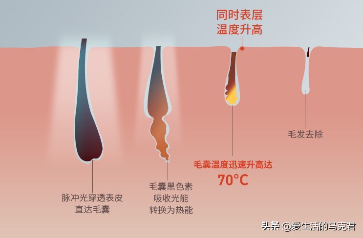 家用脱毛仪哪个牌子脱毛效果最好,家用脱毛仪是不是智商税