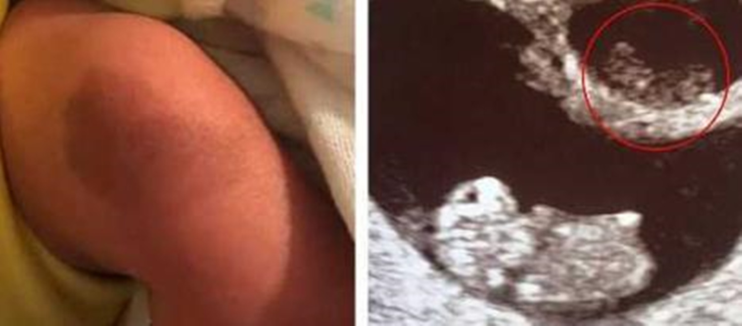 龙凤胎姐姐腹中被“吸收”，弟弟出生后腿上胎记引关注，让人动容