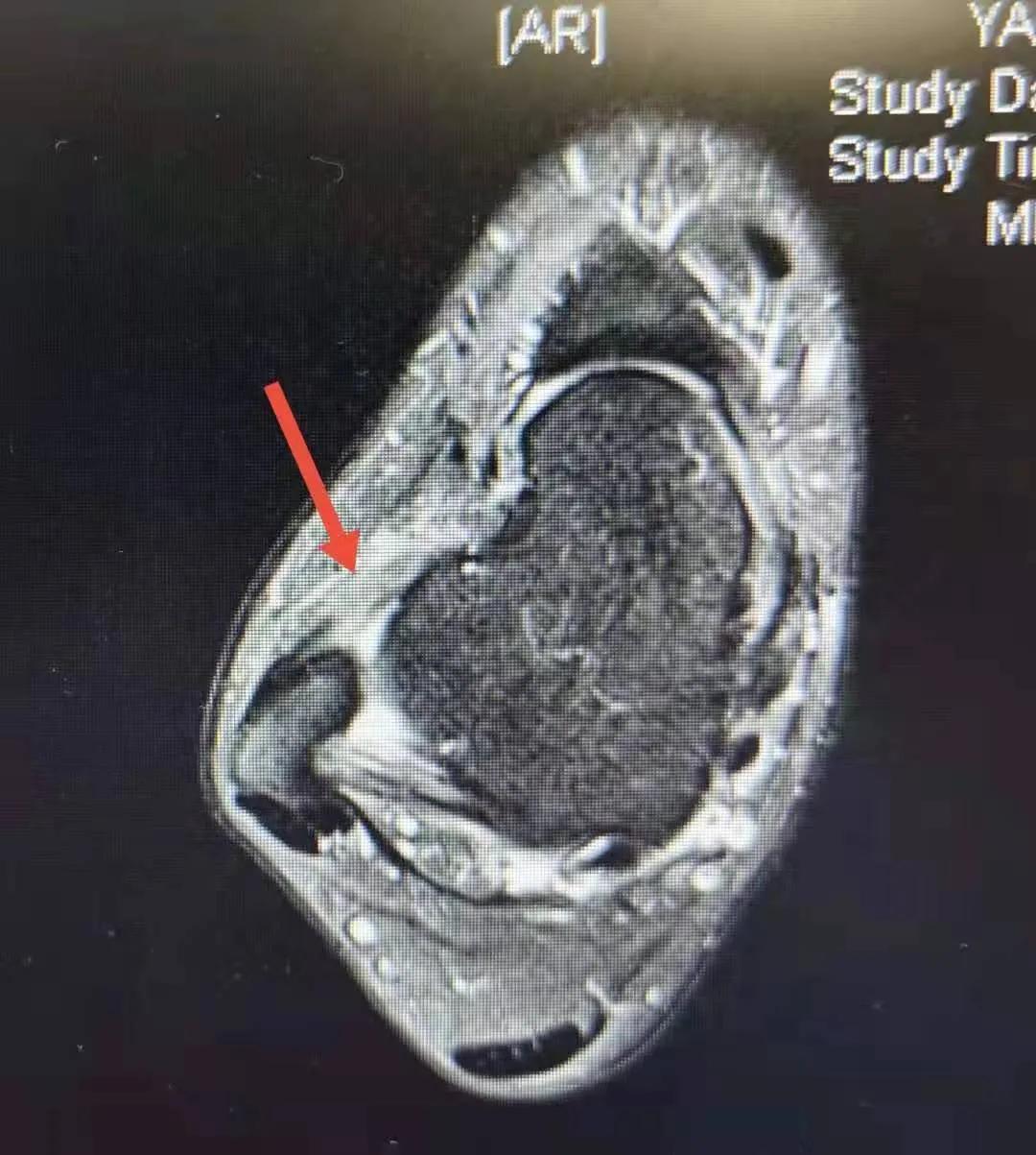 脚踝韧带扭伤的四个恢复阶段,扭脚之后一直不消肿