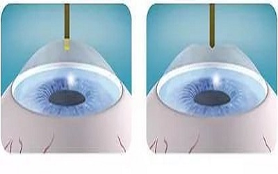 做近视手术老了之后有什么弊端,飞秒激光近视手术的弊端