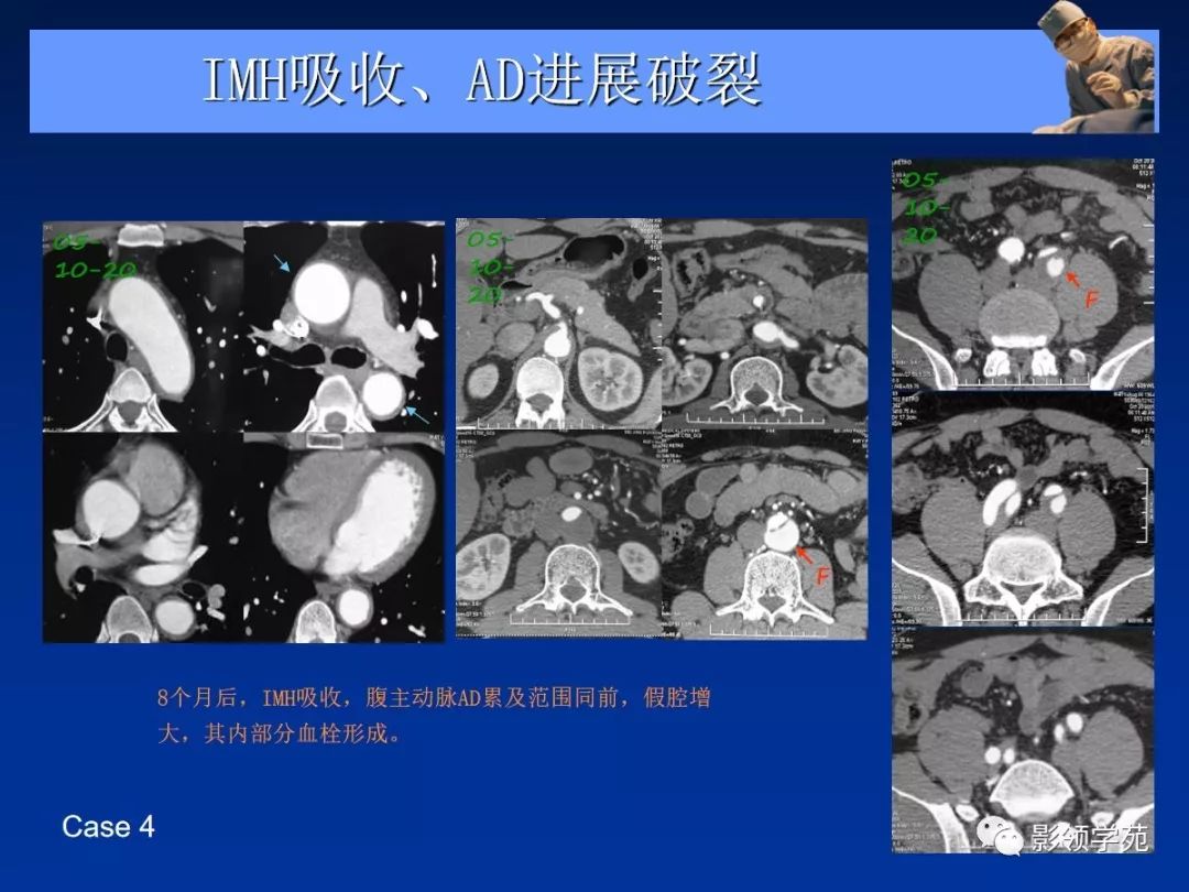 主动脉夹层壁间血肿如何鉴别,主动脉夹层血肿溃疡