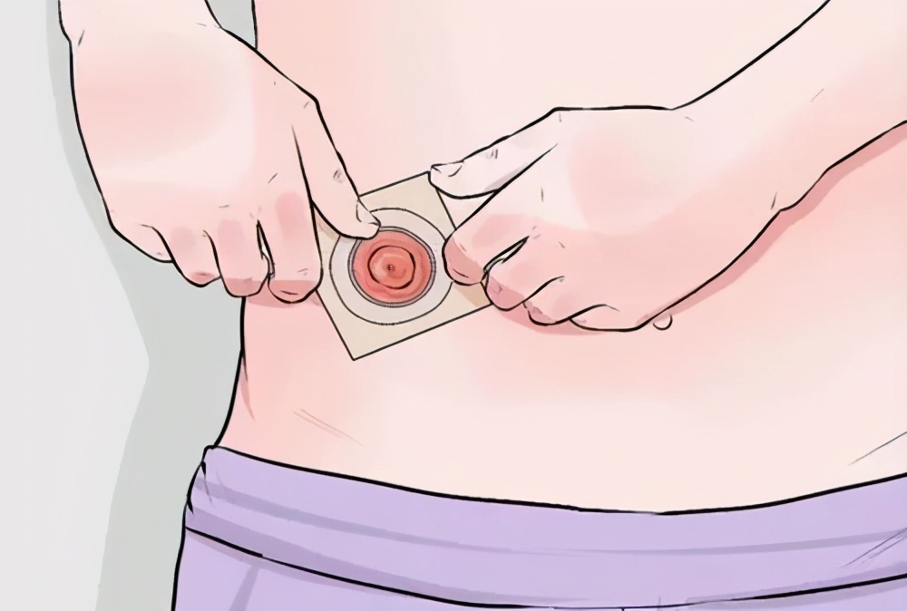 造口患者需要注意什么,造口患者饮食注意事项有哪些