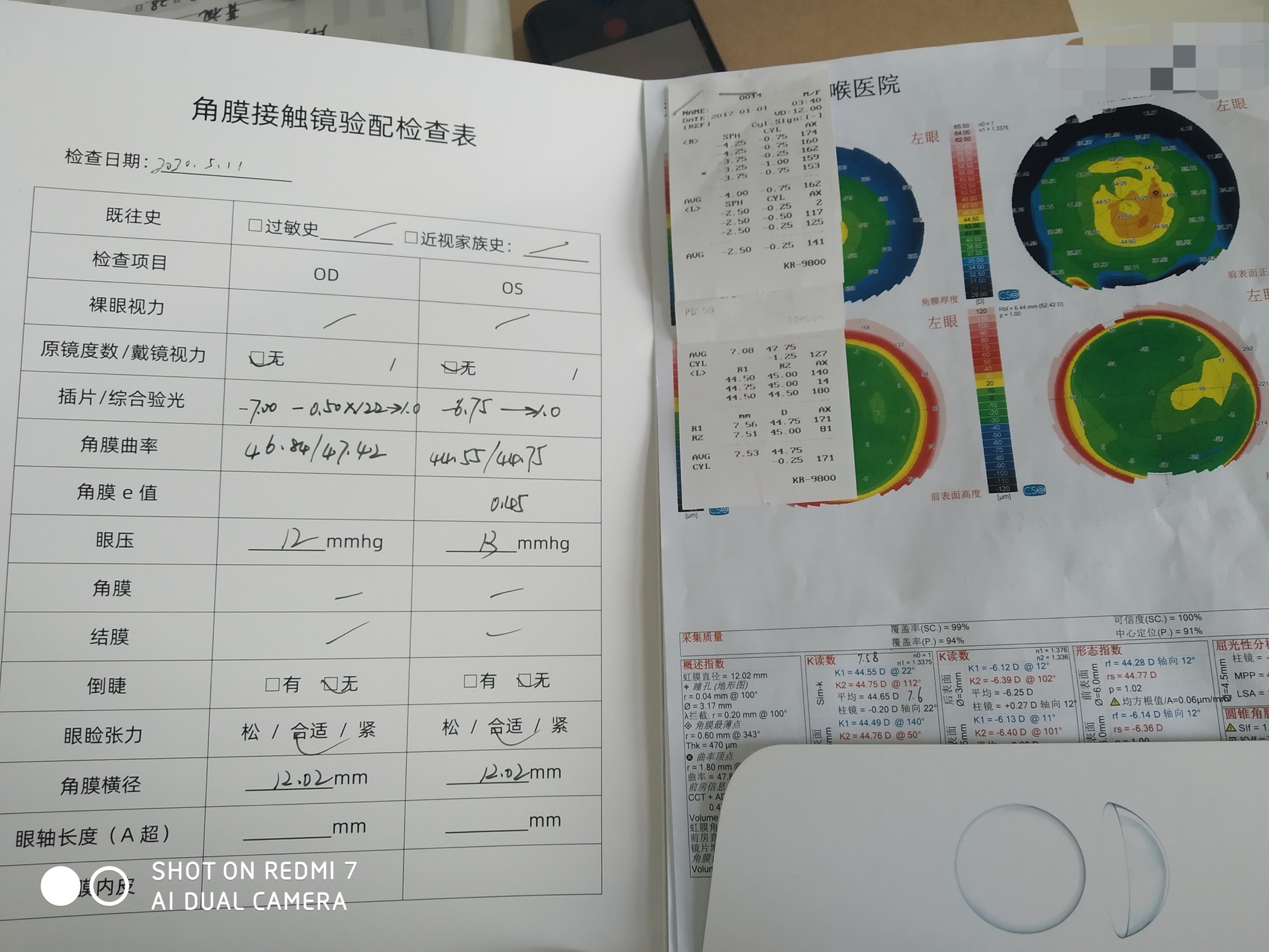2000度近视50岁怎么治疗,孩子眼睛近视600度如何治疗
