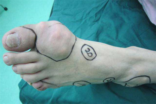 痛风石一般尿酸多少达标,尿酸从612降到532