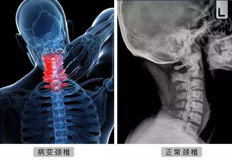 颈椎死穴的位置图解,治颈椎的死穴