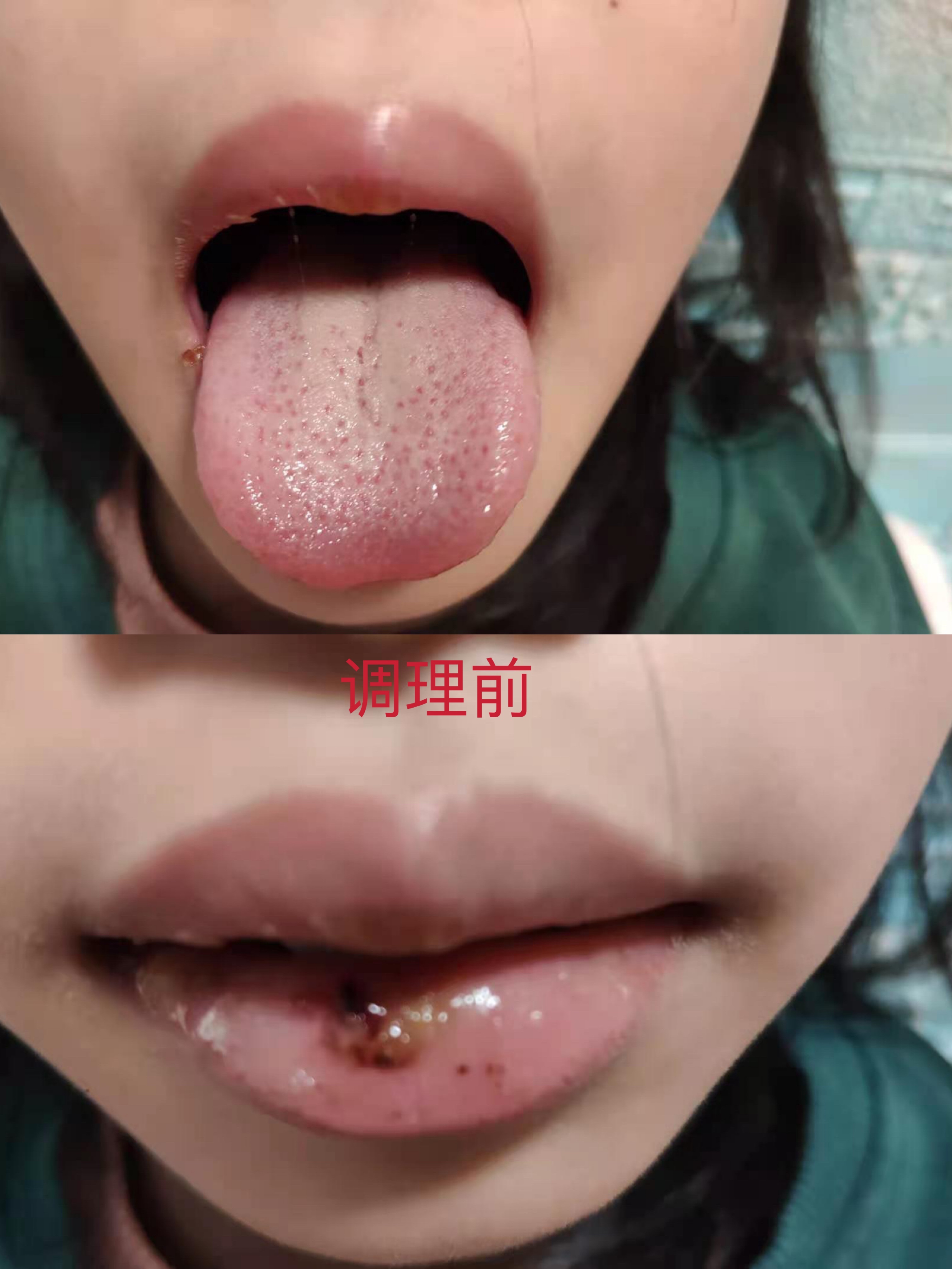 小儿积食发热中医解决方法,积食发热的中医治疗