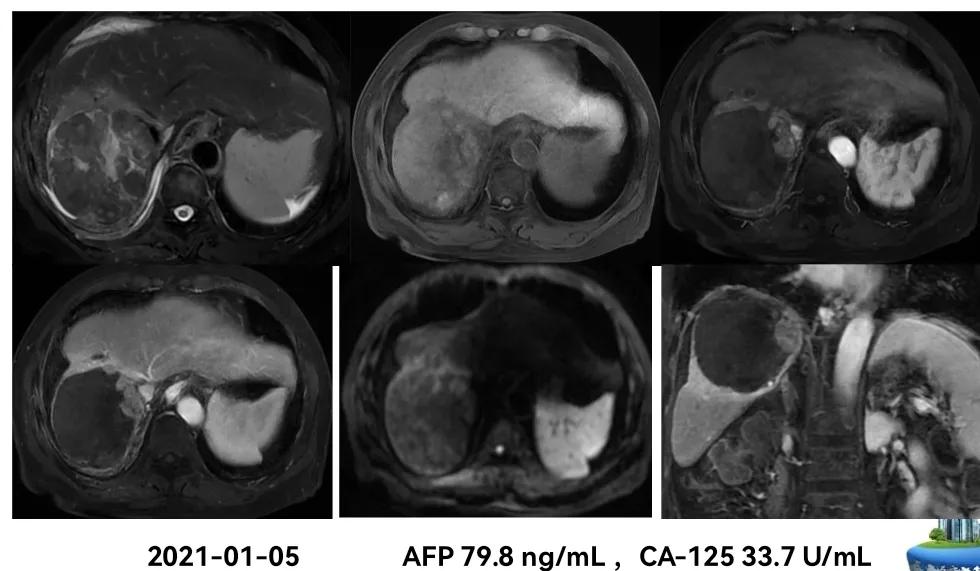 肝癌晚期靶向治疗怎么做,中国肝癌tace治疗展望