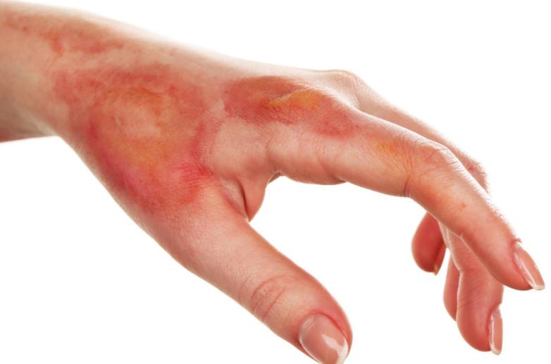 啤酒引发痛风的原因,为什么外国的啤酒不会导致痛风