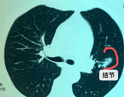 考虑肺癌伴淋巴结转移是肺癌吗,65岁肺癌晚期转移淋巴能活多久