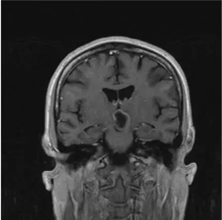 各种囊肿的症状,颅内囊肿18-19mm严重吗