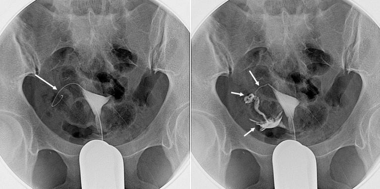 介入别人婚姻导致其怀孕犯法吗,介入科对生育的影响