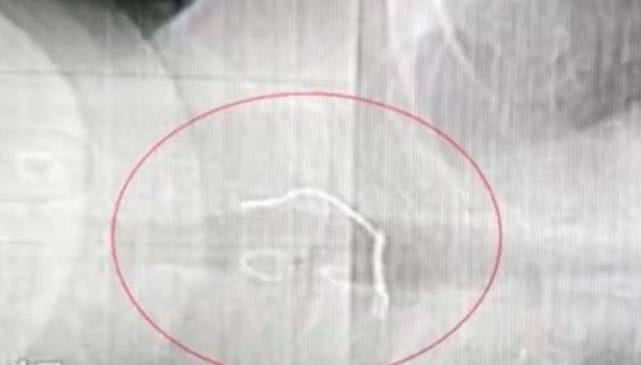 老伯误把6厘米铁丝当做梅干菜吃进肚里，致使食道穿孔险些丧命