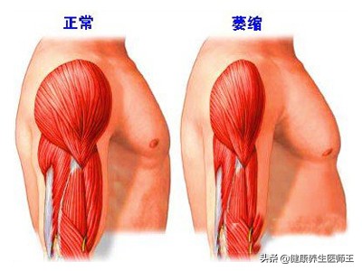 人体健康之运动神经元病,运动神经元病的锻炼方法