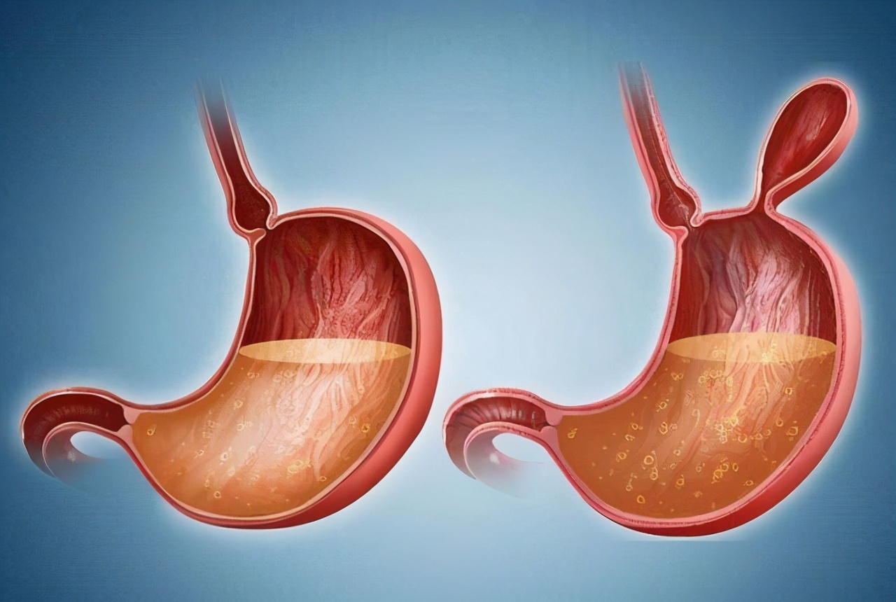 胃食管结合部腺癌预后怎样,食管胃结合部癌的外科治疗策略