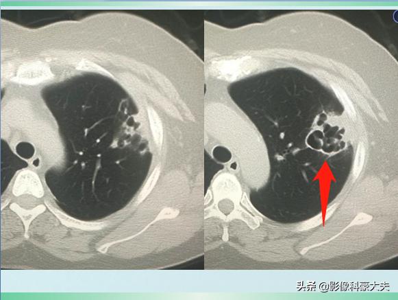 肺炎比肺结核严重吗,新冠肺炎对癌症有影响吗