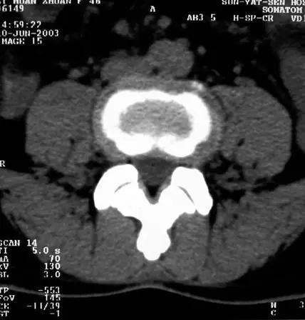 颈椎腰椎疾病ct及mri诊断,腰椎ct可以发现肠部病变吗