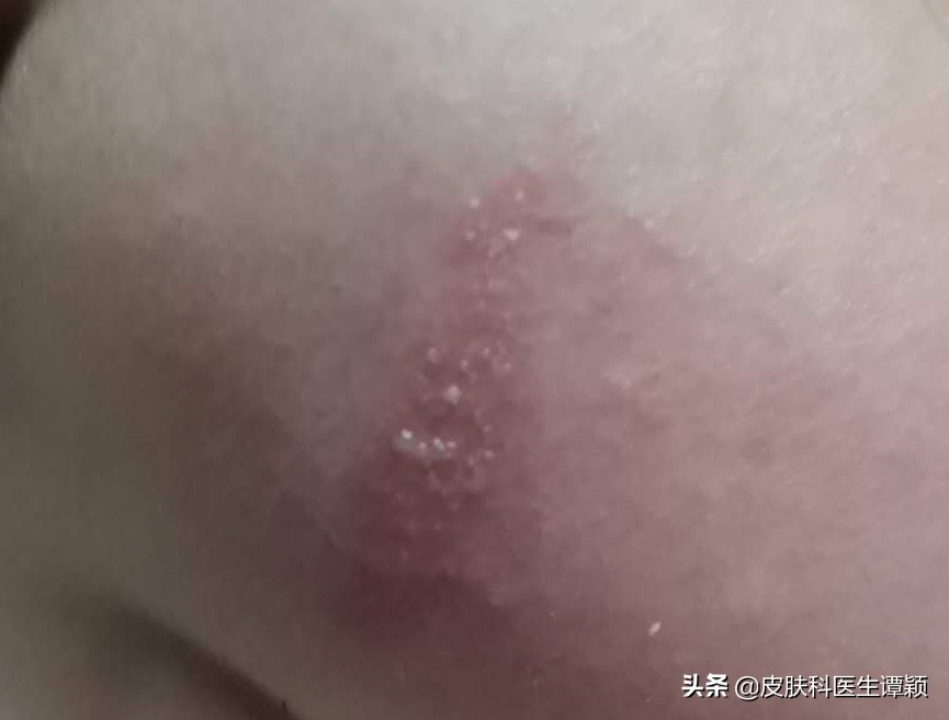 隐翅虫皮炎的危害有哪些,隐翅虫皮炎发痒是什么原因