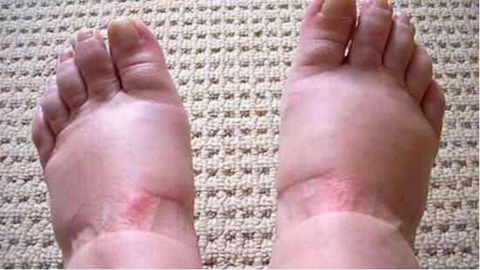 浮肿喝水排尿少怎么回事,孕期水肿还要多喝水吗