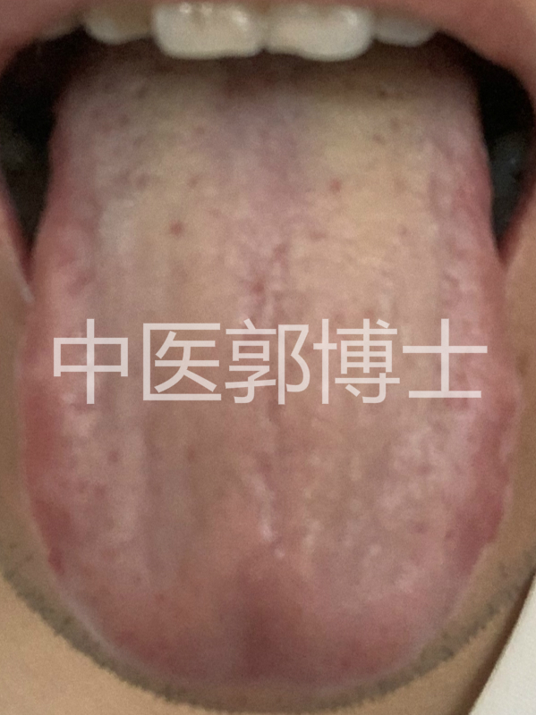 因借酒消愁，左上腹隐痛，腹胀腹泻，中药配合心理疏导，效果更好
