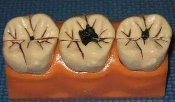 刷牙把牙齿根刷有条缝怎么办,横向刷牙把牙齿快刷断了怎么补救