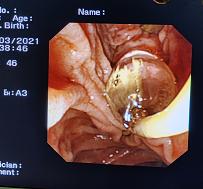消化内镜技术近5年的新进展,腹腔镜下胆总管切开取石术恢复快