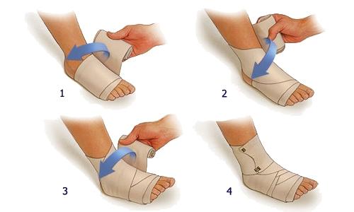 运动中踝关节扭伤的动画科普视频,踝关节扭伤症状评估