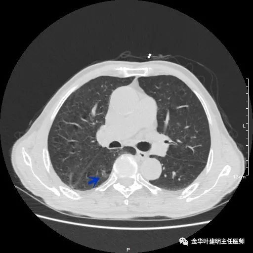 多发原发肺癌能根治吗,肺部原发性恶性肿瘤好治