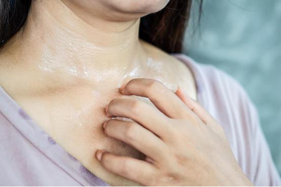 紫外线过敏皮炎擦什么软膏,夏天容易紫外线过敏是什么原因