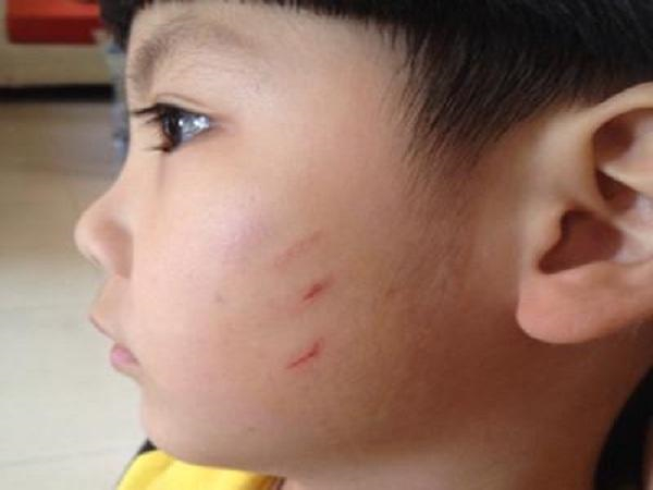 孩子在幼儿园被抓脸怎么处理,孩子幼儿园第一天开学就被抓破脸