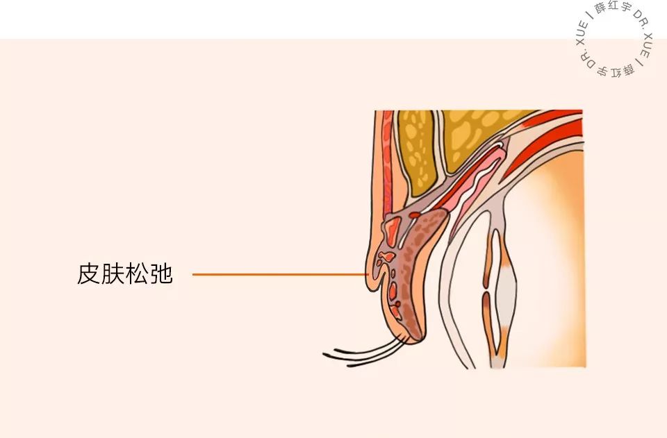 无痕双眼皮大概要多少钱,无痕双眼皮闭眼有痕