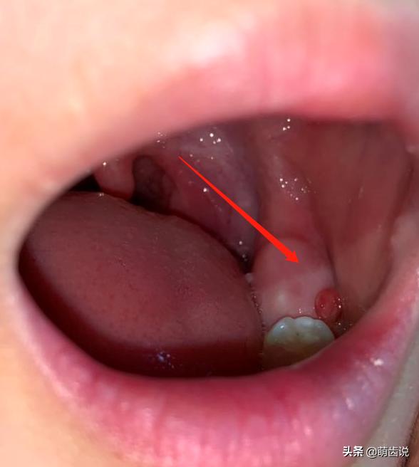 宝宝六龄牙怎么保护,六岁孩子牙做什么保护