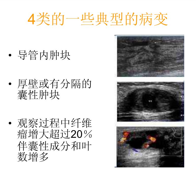 乳腺bi-rads分类有哪些,乳腺bi-rads的分类