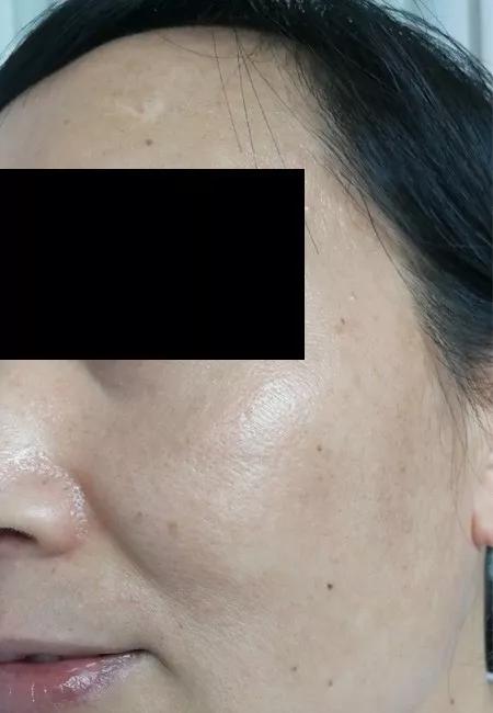 皮肤科医生告诉你，如何让痘痘不再复发