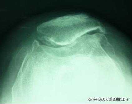 医院治髌骨软化症怎么样,专家教你快速治疗膝关节