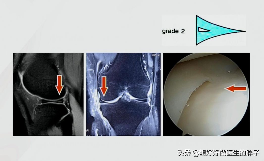足球运动员有半月板问题吗,足球运动员为什么没有半月板