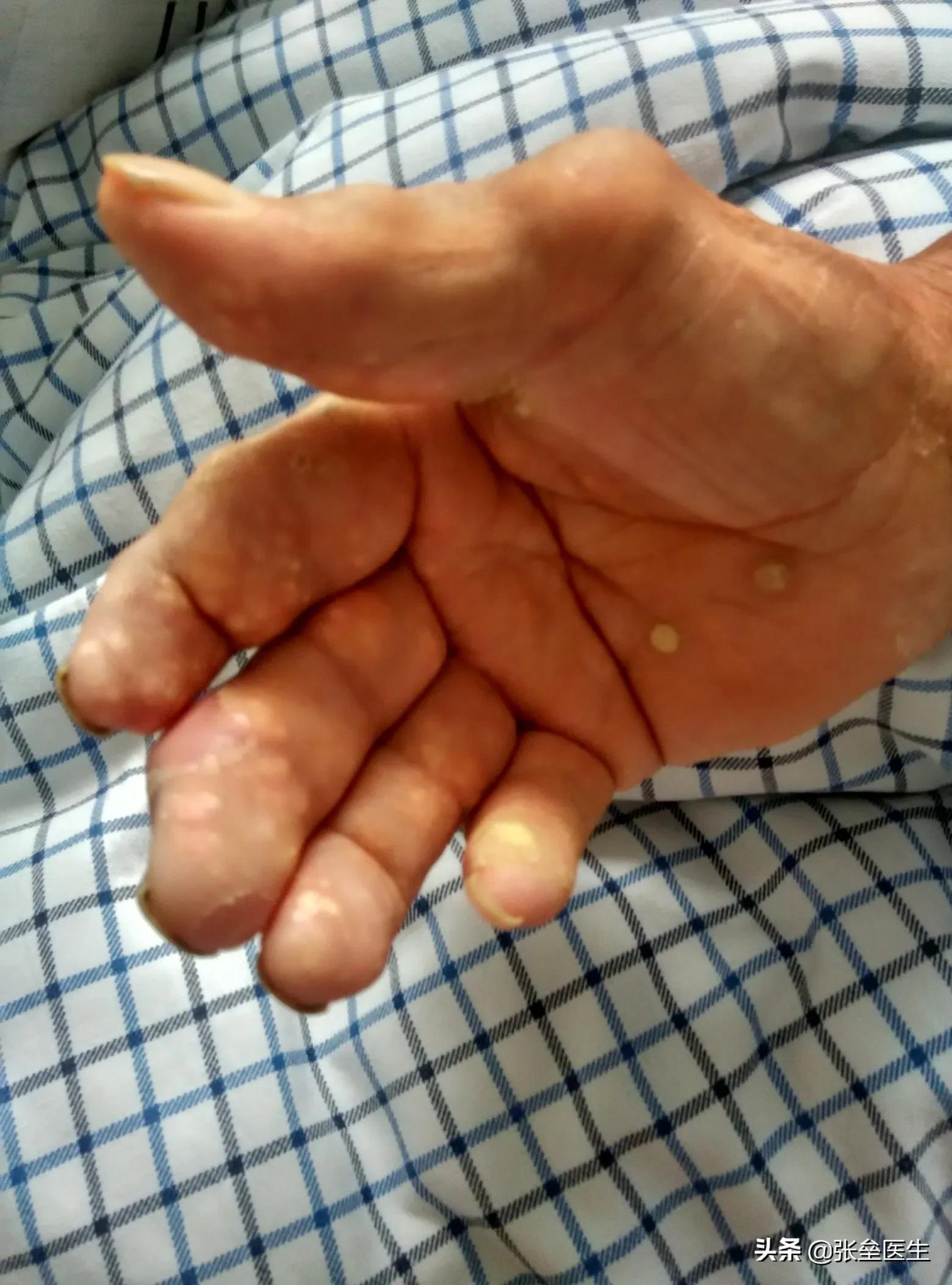 50%痛风患者无法工作和下地干活,在家突然痛风如何紧急减痛