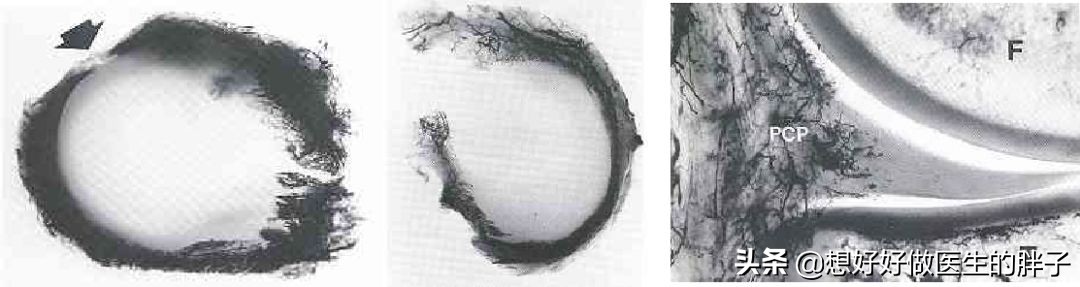 足球运动员有半月板问题吗,足球运动员为什么没有半月板