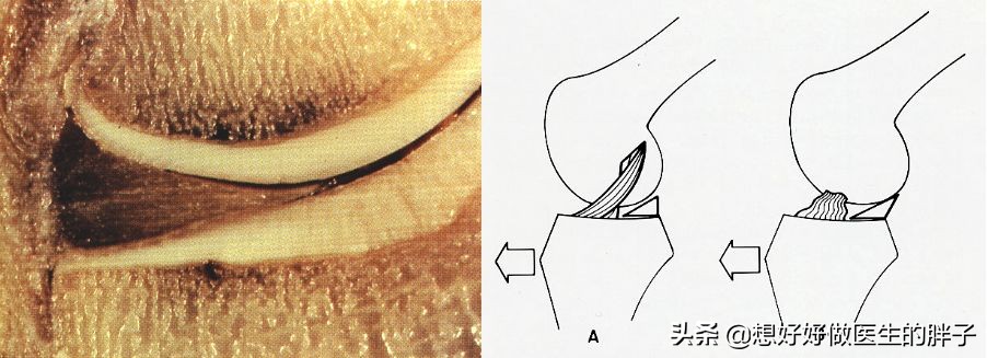 为什么足球运动员不会半月板受伤,半月板伤病对足球运动员影响大吗