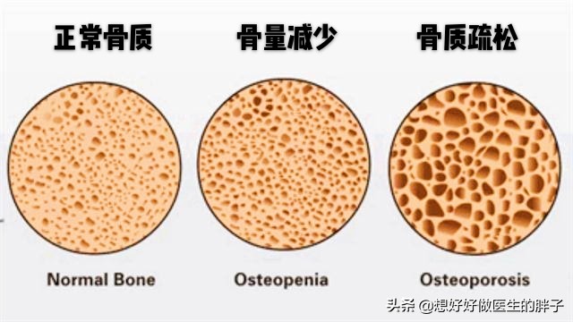 女性绝经期出现骨痛，提示可能骨质疏松了，医生教您如何系统应对