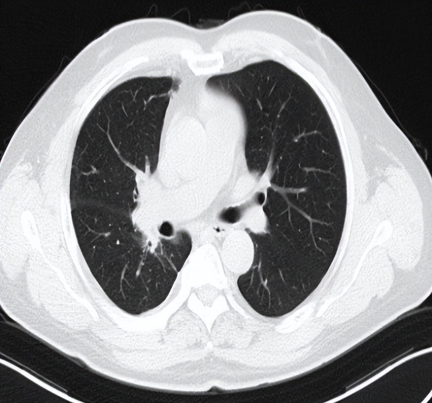 海南首例恶性胸膜间皮瘤,胸膜间皮瘤生存5年算治愈吗