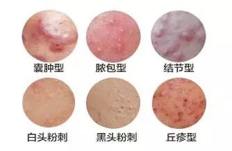 脸上痘痘挤出来白色一坨的是什么,痘痘里面有一粒白色的粉刺