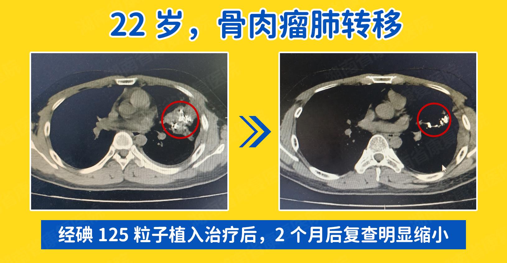 粒子植入术：一根针“排兵布阵”，精准剿灭癌细胞