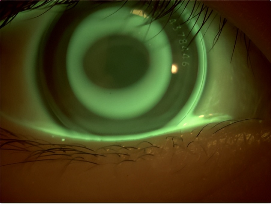 角膜接触镜验配案例图解,戴角膜塑形镜反复出现点染的原因