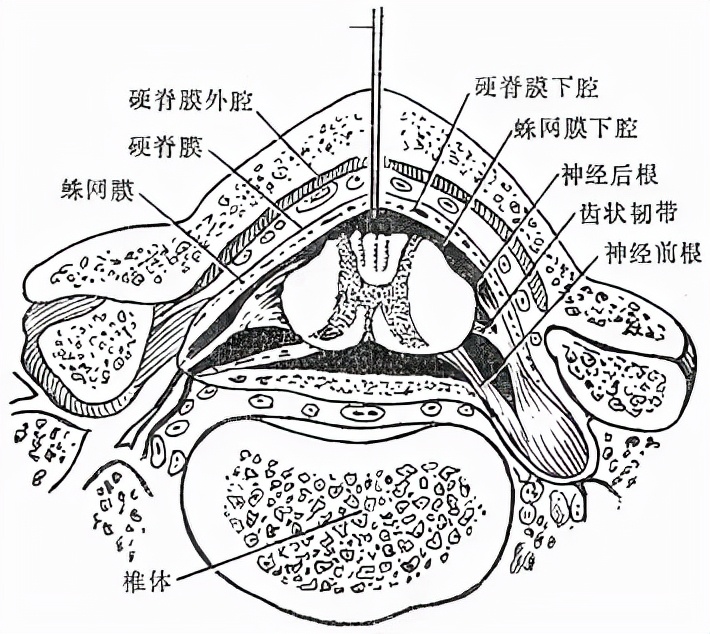 颈椎间盘突出压迫脊髓严重吗,颈椎压迫脊髓硬膜囊怎么办