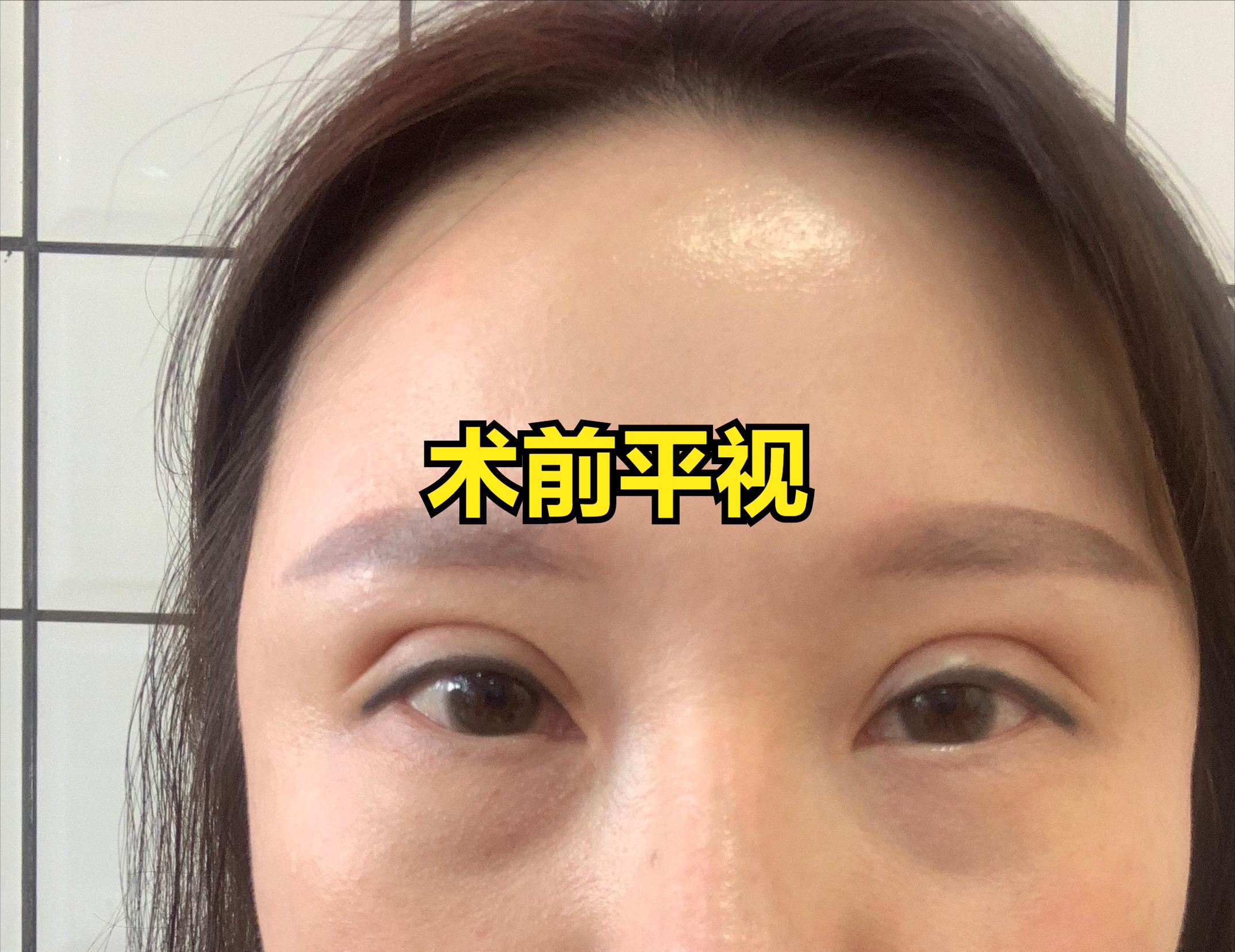 整容失败大眼女,整容12次失败之后长什么样