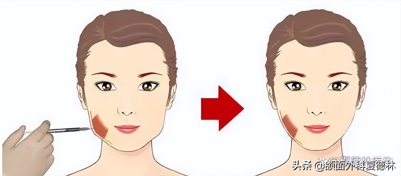 如何预防脸发腮,什么样的脸容易发腮