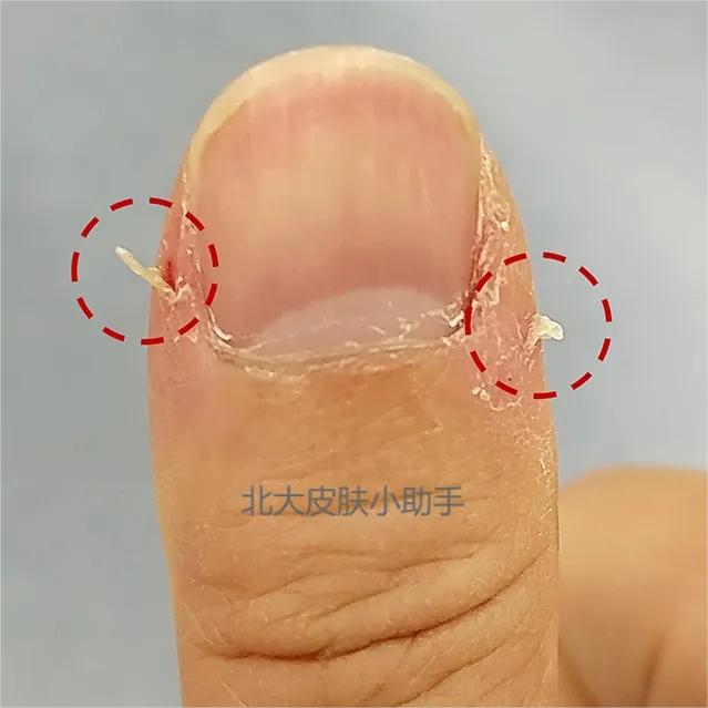 手贱，爱抠手皮、撕手皮、咬手指！指甲旁的死皮可以直接撕掉吗？