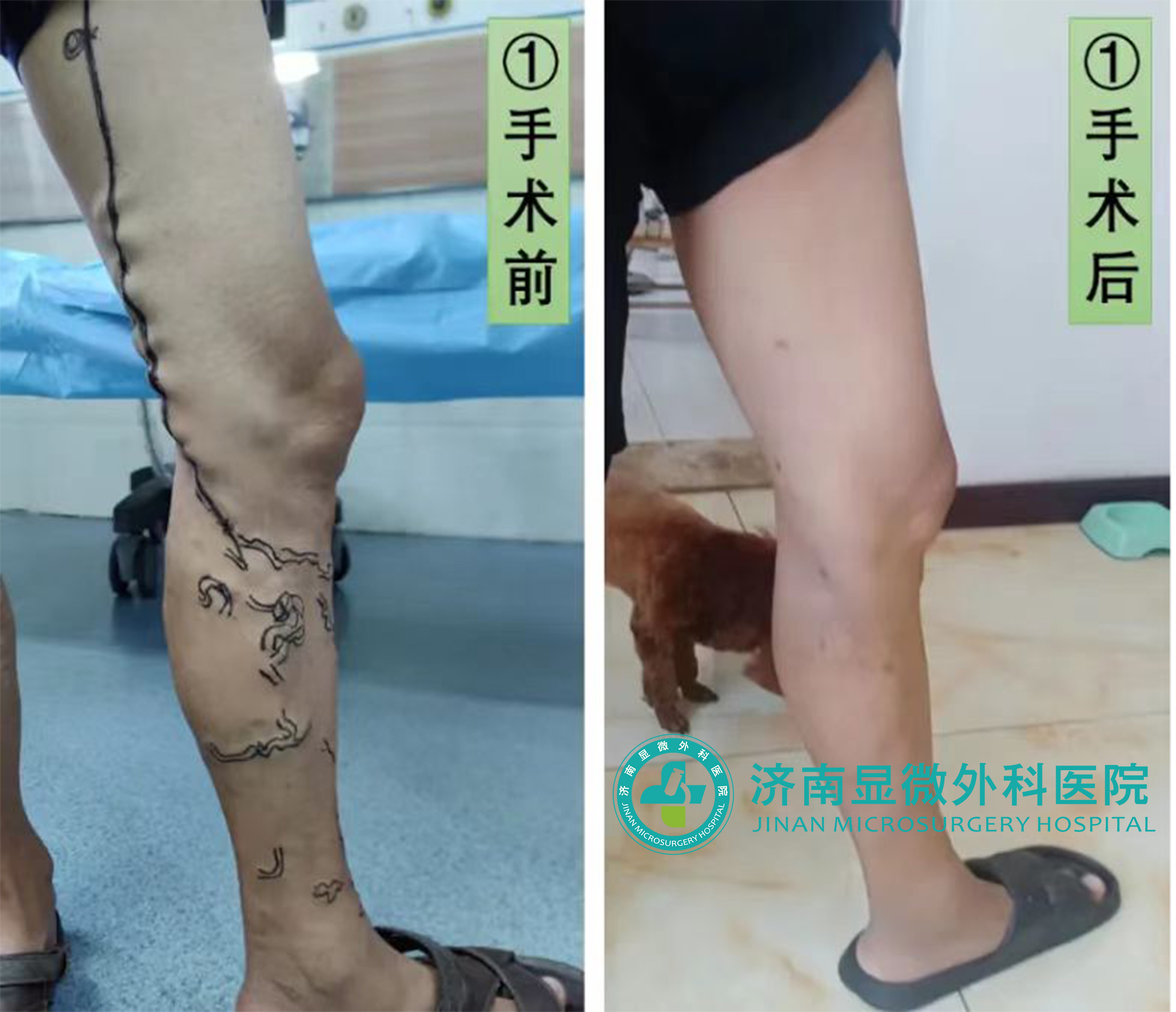 静脉曲张三氧治疗的危害,静脉曲张放血治疗的危害