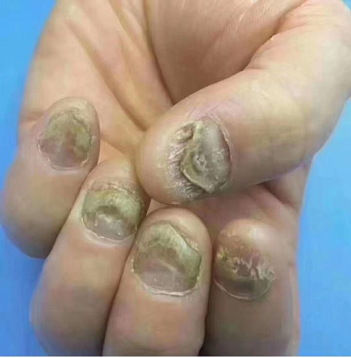 有了灰指甲又丑又尴尬,灰指甲患者必看治愈灰指甲的秘诀