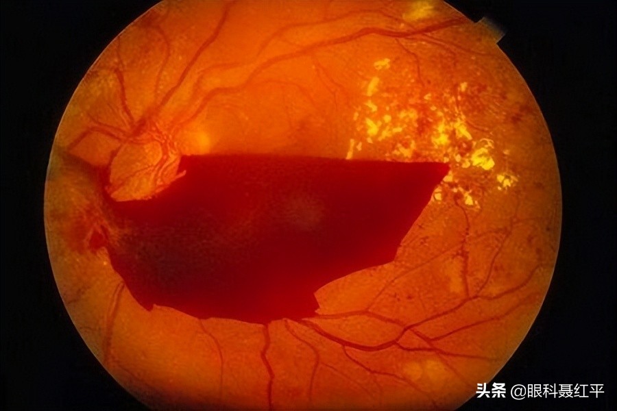 眼底出血的原因和治疗是什么,眼底出血有哪些表现该怎么办